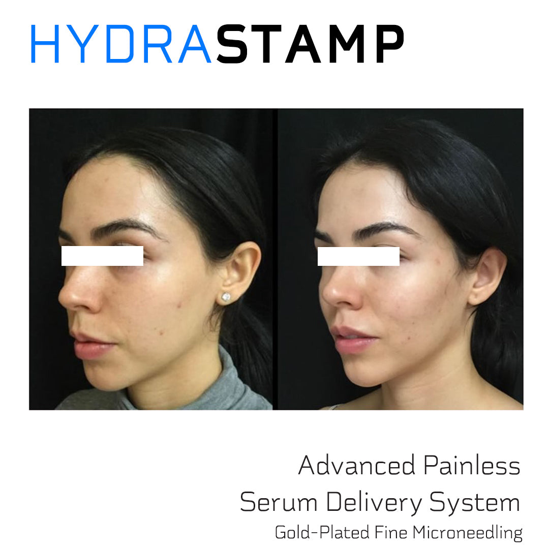 HYDRASTAMP DIY Facial Derma EZ Jet Microneedling Kit (For Skin Brightening, Wrinkle Reduction and Overall Skin Rejuvenation)