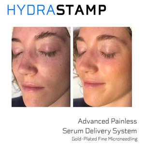 HYDRASTAMP DIY Facial Derma EZ Jet Microneedling Kit (For Skin Brightening, Wrinkle Reduction and Overall Skin Rejuvenation)
