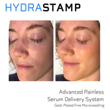 Load image into Gallery viewer, HYDRASTAMP DIY Facial Derma EZ Jet Microneedling Kit (For Uneven Skin Texture, Pores and Scars)
