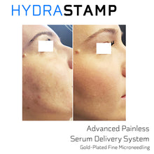 Load image into Gallery viewer, [Serum Pack] HYDRASTAMP DIY Derma EZ Jet EGF Stem Cell  (For Uneven Skin Texture, Pores and Scars)
