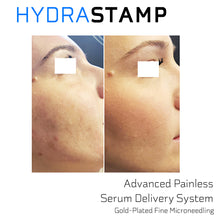 Load image into Gallery viewer, HYDRASTAMP DIY Facial Derma EZ Jet Microneedling Kit (For Uneven Skin Texture, Pores and Scars)