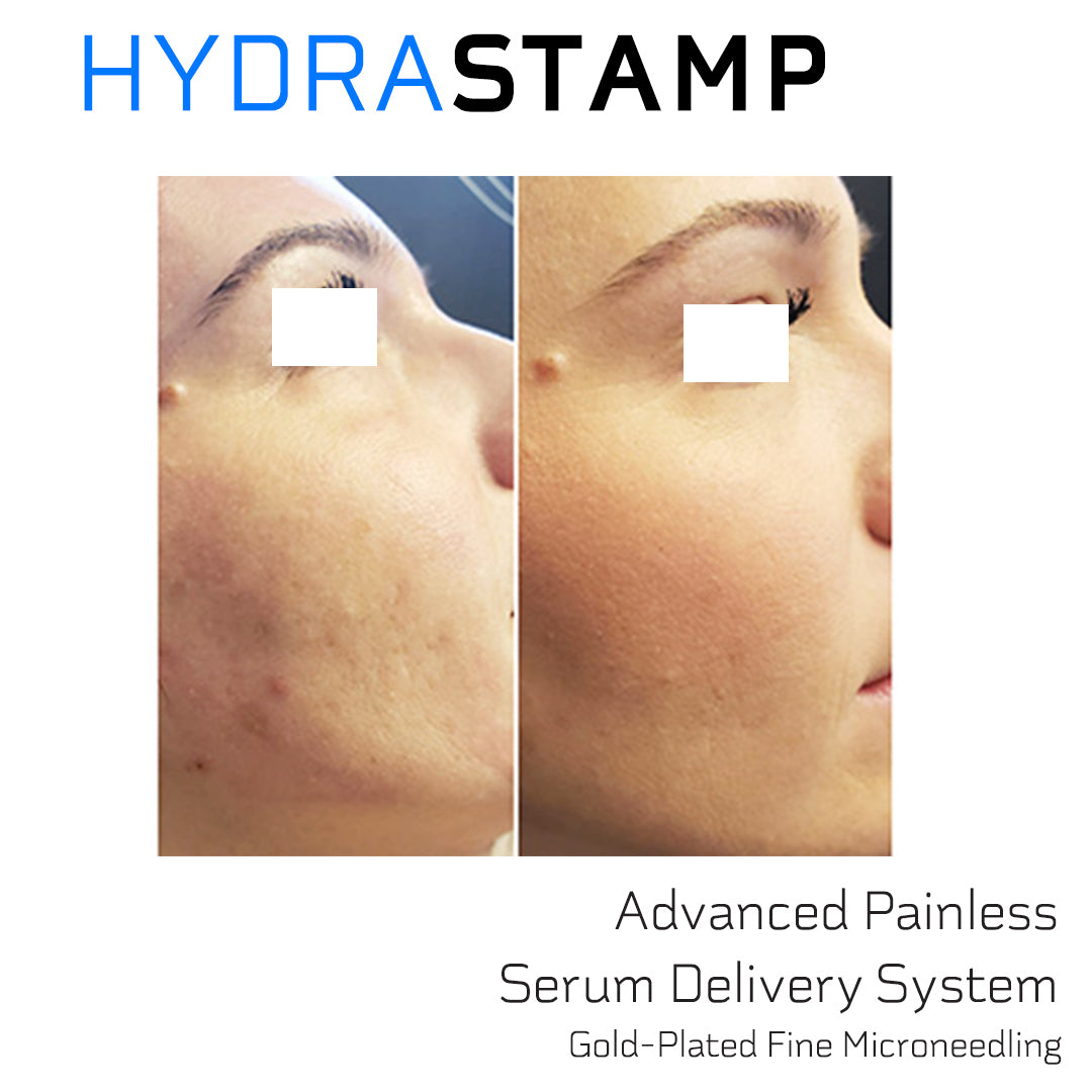 HYDRASTAMP DIY Facial Derma EZ Jet Microneedling Kit (For Skin Brightening, Wrinkle Reduction and Overall Skin Rejuvenation)
