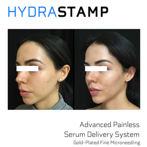 HYDRASTAMP DIY Facial Derma EZ Jet Microneedling Kit (For Uneven Skin Texture, Pores and Scars)